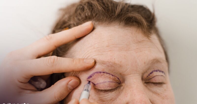 blepharoplasty-pre-op-eye-markup-face-surgery-modi-2026-02-15-01-09-18-utc