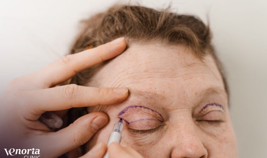 blepharoplasty-pre-op-eye-markup-face-surgery-modi-2026-02-15-01-09-18-utc