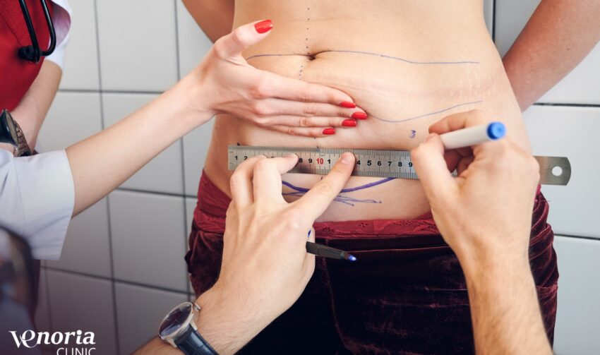 Close up of medical worker helping doctor to draw marks on woman body before plastic surgery. Plastic surgeon using ruler while drawing line on abdomen of female patient. Concept of abdominoplasty